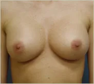 Breast augmentation after photo 1
